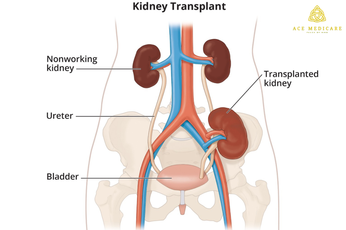 The Ultimate Guide to Kidney Transplant: Everything You Need to Know